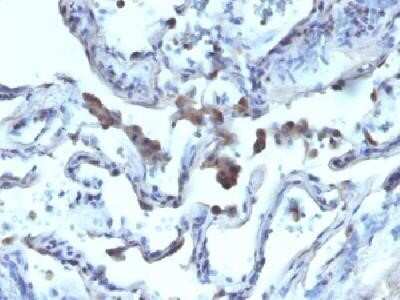 Immunohistochemistry-Paraffin: alpha-Methylacyl-CoA Racemase/AMACR Antibody - Azide and BSA Free [NBP2-34514] - Formalin-fixed, paraffin-embedded human Lung carcinoma stained with AMACR/ p504S Rabbit polyclonal antibody.