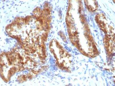 Immunohistochemistry-Paraffin: alpha-Methylacyl-CoA Racemase/AMACR Antibody - IHC-Prediluted [NBP2-48130] - Human Prostate Carcinoma stained with AMACR / p504S Rabbit Polyclonal Antibody.