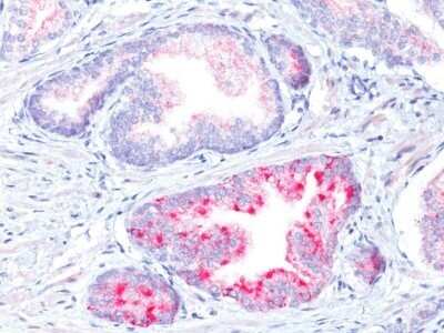 Immunohistochemistry-Paraffin: alpha-Methylacyl-CoA Racemase/AMACR Antibody - IHC-Prediluted [NBP2-48130] - Formalin-fixed, paraffin-embedded human prostate carcinoma (20X) stained with AMACR / p504S Rabbit PAb.