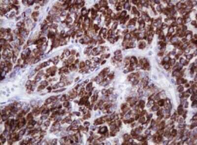 Immunohistochemistry: alpha-Methylacyl-CoA Racemase/AMACR Antibody (OTI5F10) [NBP2-45491] - Analysis of Carcinoma of Human liver tissue.(Heat-induced epitope retrieval by 10mM citric buffer, pH6.0, 120C for 3min)