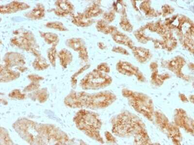 Immunohistochemistry-Paraffin: alpha-Methylacyl-CoA Racemase/AMACR Antibody (AMACR/1723) - Azide and BSA Free [NBP2-54501] - Formalin-fixed, paraffin-embedded human Prostate Carcinoma  Stained with AMACR / p504S Monoclonal Antibody (AMACR/1723)