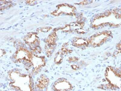 Immunohistochemistry-Paraffin: alpha-Methylacyl-CoA Racemase/AMACR Antibody (AMACR/4572R) - Azide and BSA Free [NBP3-08468] - Formalin-fixed, paraffin-embedded human prostate carcinoma stained with alpha-Methylacyl-CoA Racemase/AMACR Recombinant Rabbit Monoclonal Antibody (alpha-Methylacyl-CoA Racemase/AMACR/4572R).
