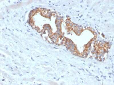 Immunohistochemistry-Paraffin: alpha-Methylacyl-CoA Racemase/AMACR Antibody (AMACR/4572R) - Azide and BSA Free [NBP3-08468] - Formalin-fixed, paraffin-embedded human prostate carcinoma stained with alpha-Methylacyl-CoA Racemase/AMACR Recombinant Rabbit Monoclonal Antibody (alpha-Methylacyl-CoA Racemase/AMACR/4572R).