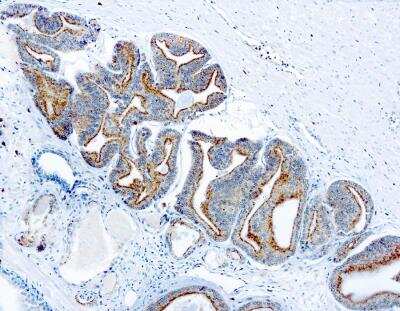 Immunohistochemistry-Paraffin: alpha-Methylacyl-CoA Racemase/AMACR Antibody [NB120-12498] - Formalin fixed paraffin embedded prostate carcinoma stained with p504S antibody (NB120-12498). 