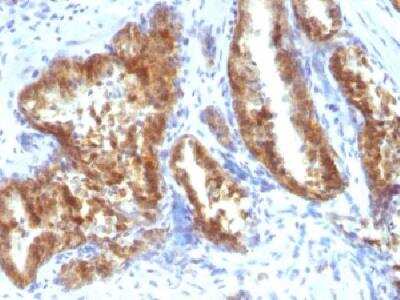 Immunohistochemistry-Paraffin: alpha-Methylacyl-CoA Racemase/AMACR Antibody [NBP2-32916] - Formalin-fixed, paraffin-embedded human prostate carcinoma with AMACR/p504S Rabbit polyclonal antibody.