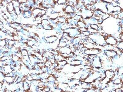 Immunohistochemistry-Paraffin: alpha-Smooth Muscle Actin Antibody (1A4 + ACTA2/791) [NBP2-47699] - Azide and BSA Free [NBP2-47699] - Paraffin-embedded Human Angiosarcoma stained with alpha-Smooth Muscle Actin Monoclonal Antibody (1A4 + ACTA2/791).