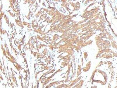 Immunohistochemistry-Paraffin: alpha-Smooth Muscle Actin Antibody (1A4 + ACTA2/791) [NBP2-47699] - Azide and BSA Free [NBP2-47699] - Paraffin-embedded Human Leiomyosarcoma stained with alpha-Smooth Muscle Actin Monoclonal Antibody (1A4 + ACTA2/791).