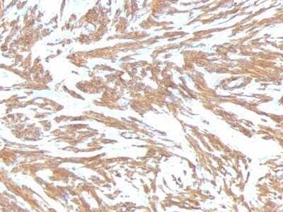 Immunohistochemistry-Paraffin: alpha-Smooth Muscle Actin Antibody (ACTA2/791) - Azide and BSA Free [NBP2-47698] - Azide and BSA Free [NBP2-47698] - Paraffin-embedded Human Leiomyosarcoma stained with alpha-Smooth Muscle Actin Monoclonal Antibody (ACTA2/791).