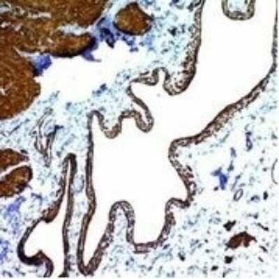 Immunohistochemistry-Paraffin: alpha-Smooth Muscle Actin Antibody (ACTA2/791) - Azide and BSA Free [NBP2-47698] - Azide and BSA Free [NBP2-47698] - Paraffin-embedded Human Leiomyosarcoma stained with alpha-Smooth Muscle Actin Monoclonal Antibody (ACTA2/791).