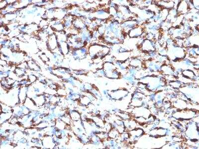 Immunohistochemistry-Paraffin: alpha-Smooth Muscle Actin Antibody (ACTA2/791) - IHC-Prediluted [NBP2-48132] - IHC-Prediluted [NBP2-48132] - Paraffin-embedded Human Angiosarcoma stained with alpha-Smooth Muscle Actin Monoclonal Antibody (ACTA2/791).