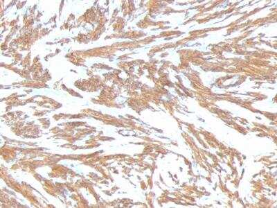 Immunohistochemistry-Paraffin: alpha-Smooth Muscle Actin Antibody (ACTA2/791) - IHC-Prediluted [NBP2-48132] - IHC-Prediluted [NBP2-48132] - Paraffin-embedded Human Leiomyosarcoma stained with alpha-Smooth Muscle Actin Monoclonal Antibody (ACTA2/791).