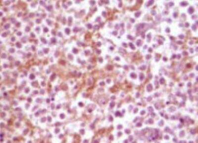Immunohistochemistry-Paraffin: alpha-Synuclein Antibody (2B2D1) [NB110-89444] - Analysis of human glioma tissue, showing membrane localization using SNCA mouse mAb with DAB staining.