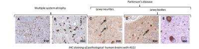 Immunohistochemistry: alpha-Synuclein Antibody (AS11) [HRP] [DDX0910-HRPO-100] - IHC staining of pathological human brains with AS11