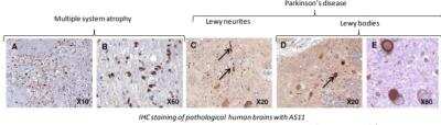 <b>Independent Antibodies Validation. </b>Immunohistochemistry: alpha-Synuclein Antibody (AS11) [DDX0910P-100] - IHC staining of pathological human brains with AS11