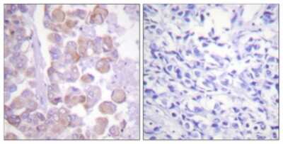 Immunohistochemistry-Paraffin: alpha-Synuclein Antibody [NBP1-61418] - Analysis of paraffin-embedded human breast carcinoma tissue, using alpha-Synuclein  Antibody. The picture on the right is treated with the synthesized peptide.