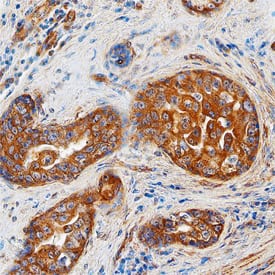 ST8 a-2,8-Sialyltransferase 8A/ST8SIA1 was detected in immersion fixed paraffin-embedded sections of human breast cancer tissue using Sheep Anti-Human ST8 a-2,8-Sialyltransferase 8A/ST8SIA1 Antigen Affinity-purified Polyclonal Antibody (Catalog # AF6716) at 5 µg/mL overnight at 4 °C. Tissue was stained using the Anti-Sheep HRP-DAB Cell & Tissue Staining Kit (brown; Catalog # CTS019) and counterstained with hematoxylin (blue). Specific staining was localized to cytoplasm of epithelial cells. View our protocol for Chromogenic IHC Staining of Paraffin-embedded Tissue Sections.