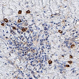20S Immunoproteasome was detected in immersion fixed paraffin-embedded sections of human lung cancer tissue using Mouse Anti-Human 20S Immunoproteasome Polyclonal Antibody (Catalog # MAB81941) at 5 µg/mL for 1 hour at room temperature followed by incubation with the Anti-Mouse IgG VisUCyte™ HRP Polymer Antibody (Catalog # VC001). Tissue was stained using DAB (brown) and counterstained with hematoxylin (blue). Specific staining was localized to cancer cell cytoplasm. View our protocol for IHC Staining with VisUCyte HRP Polymer Detection Reagents.