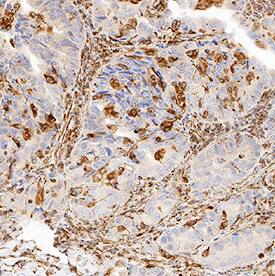 20S Proteasome was detected in immersion fixed paraffin-embedded sections of human lung cancer tissue using Mouse Anti-Human 20S Proteasome Monoclonal Antibody (Catalog # MAB95541) at 5 µg/mL for 1 hour at room temperature followed by incubation with the Anti-Mouse IgG VisUCyte™ HRP Polymer Antibody (Catalog # VC001). Tissue was stained using DAB (brown) and counterstained with hematoxylin (blue). Specific staining was localized to cytoplasm and nuclei in cancer cells. View our protocol for IHC Staining with VisUCyte HRP Polymer Detection Reagents.