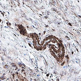 4-Hydroxynonenal was detected in immersion fixed paraffin-embedded sections of human prostate using Mouse Anti-4-Hydroxynonenal Monoclonal Antibody (Catalog # MAB3249) at 0.1 µg/mL for 1 hour at room temperature followed by incubation with the Anti-Mouse IgG VisUCyte™ HRP Polymer Antibody (Catalog # VC001). Before incubation with the primary antibody, tissue was subjected to heat-induced epitope retrieval using Antigen Retrieval Reagent-Basic (Catalog # CTS013). Tissue was stained using DAB (brown) and counterstained with hematoxylin (blue). Specific staining was localized to cytoplasm. View our protocol for IHC Staining with VisUCyte HRP Polymer Detection Reagents.