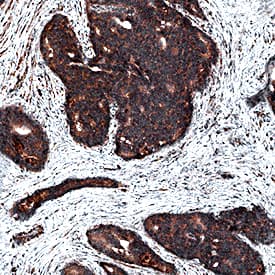 4-Hydroxynonenal was detected in immersion fixed paraffin-embedded sections of human prostate cancer tissue using Mouse Anti-4-Hydroxynonenal Monoclonal Antibody (Catalog # MAB3249) at 0.5 µg/mL for 1 hour at room temperature followed by incubation with the Anti-Mouse IgG VisUCyte™ HRP Polymer Antibody (Catalog # VC001). Before incubation with the primary antibody, tissue was subjected to heat-induced epitope retrieval using Antigen Retrieval Reagent-Basic (Catalog # CTS013). Tissue was stained using DAB (brown) and counterstained with hematoxylin (blue). Specific staining was localized to cytoplasm. View our protocol for IHC Staining with VisUCyte HRP Polymer Detection Reagents.