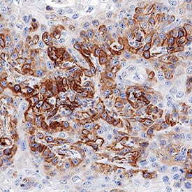 5'-Nucleotidase/CD73 was detected in immersion fixed paraffin-embedded sections of human cervical cancer tissue using Sheep Anti-Human 5'-Nucleotidase/CD73 Antigen Affinity-purified Polyclonal Antibody (Catalog # AF5795) at 1 µg/mL overnight at 4 °C. Tissue was stained using the Anti-Sheep HRP-DAB Cell & Tissue Staining Kit (brown; Catalog # CTS019) and counterstained with hematoxylin (blue). Specific staining was localized to plasma membranes in cancer cells. View our protocol for Chromogenic IHC Staining of Paraffin-embedded Tissue Sections.