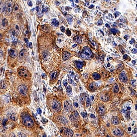 5'-Nucleotidase/CD73 was detected in immersion fixed paraffin-embedded sections of human cervical cancer tissue using Mouse Anti-Human/Mouse/Rat 5'-Nucleotidase/CD73 Monoclonal Antibody (Catalog # MAB57951) at 1.7 µg/mL for 1 hour at room temperature followed by incubation with the Anti-Mouse IgG VisUCyte™ HRP Polymer Antibody (Catalog # VC001). Tissue was stained using DAB (brown) and counterstained with hematoxylin (blue). Specific staining was localized to cytoplasm and cell membranes. View our protocol for IHC Staining with VisUCyte HRP Polymer Detection Reagents.