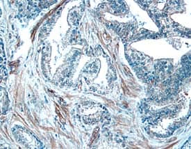 ADAM10 was detected in immersion fixed paraffin-embedded sections of human prostate cancer tissue using 5 &micro;g/mL Goat Anti-Human ADAM10 Ectodomain Polyclonal Antibody (Catalog # AB936) overnight at 4 &deg;C. Tissue was stained with the Anti-Goat HRP-DAB Cell & Tissue Staining Kit (brown; Catalog # CTS008) and counterstained with hematoxylin (blue). View our protocol for Chromogenic IHC Staining of Paraffin-embedded Tissue Sections.