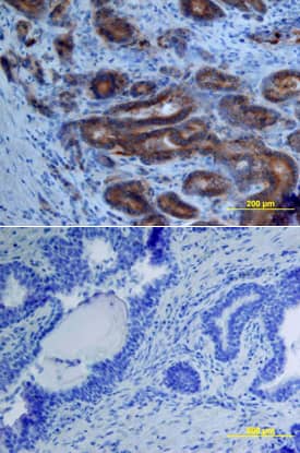 ADAM15 was detected in immersion fixed paraffin-embedded sections of human prostate array using Goat Anti-Human ADAM15 Ectodomain Biotinylated Antigen Affinity-purified Polyclonal Antibody (Catalog # BAF935) at 25 µg/mL overnight at 4 °C. Tissue was stained using the Anti-Goat HRP-DAB Cell & Tissue Staining Kit (brown; Catalog # CTS008) and counterstained with hematoxylin (blue). Lower panel shows a lack of labeling if primary antibodies are omitted and tissue is stained only with secondary antibody followed by incubation with detection reagents. View our protocol for Chromogenic IHC Staining of Paraffin-embedded Tissue Sections.