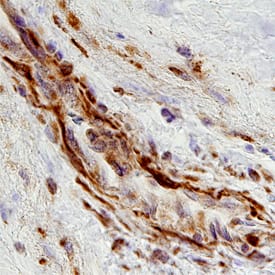 ADAMTS15 was detected in immersion fixed paraffin-embedded sections of human breast cancer tissue using Human/Mouse ADAMTS15 Antigen Affinity-purified Polyclonal Antibody (Catalog # AF5149) at 3 µg/mL overnight at 4 °C. Before incubation with the primary antibody, tissue was subjected to heat-induced epitope retrieval using Antigen Retrieval Reagent-Basic (Catalog # CTS013). Tissue was stained using the Anti-Sheep HRP-DAB Cell & Tissue Staining Kit (brown; Catalog # CTS019) and counterstained with hemotoxylin (blue). Specific staining was localized to stromal cells. View our protocol for Chromogenic IHC Staining of Paraffin-embedded Tissue Sections.