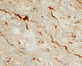 ADNP was detected in immersion fixed paraffin-embedded sections of human brain (inferior colliculus) using Goat Anti-Human ADNP Antigen Affinity-purified Polyclonal Antibody (Catalog # AF6737) at 10 µg/mL overnight at 4 °C. Before incubation with the primary antibody, tissue was subjected to heat-induced epitope retrieval using Antigen Retrieval Reagent-Basic (Catalog # CTS013). Tissue was stained using the Anti-Goat HRP-DAB Cell & Tissue Staining Kit (brown; Catalog # CTS008) and counterstained with hematoxylin (blue). Specific staining was localized to neuronal cell processes. View our protocol for Chromogenic IHC Staining of Paraffin-embedded Tissue Sections.