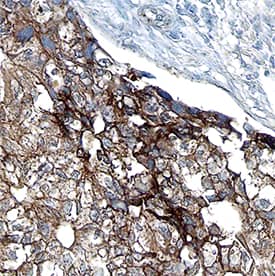 ALK-7 was detected in immersion fixed paraffin-embedded sections of human breast cancer tissue using Sheep Anti-Human ALK-7 Antigen Affinity-purified Polyclonal Antibody (Catalog # AF7749) at 15 µg/mL for 1 hour at room temperature followed by incubation with the Anti-Sheep IgG VisUCyte™ HRP Polymer Antibody (Catalog # VC006). Before incubation with the primary antibody, tissue was subjected to heat-induced epitope retrieval using Antigen Retrieval Reagent-Basic (Catalog # CTS013). Tissue was stained using DAB (brown) and counterstained with hematoxylin (blue). Specific staining was localized to cell surfaces in cancer cells. View our protocol for IHC Staining with VisUCyte HRP Polymer Detection Reagents.