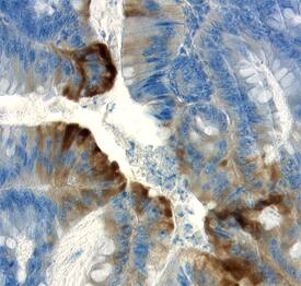 APC was detected in immersion fixed paraffin-embedded sections of human colon cancer tissue using 15 &micro;g/mL Goat Anti-Human APC C-Terminus Antigen Affinity-purified Polyclonal Antibody (Catalog # AF3695) overnight at 4 &deg;C. Tissue was stained with the Anti-Goat HRP-DAB Cell & Tissue Staining Kit (brown; Catalog # CTS008) and counterstained with hematoxylin (blue). View our protocol for Chromogenic IHC Staining of Paraffin-embedded Tissue Sections.