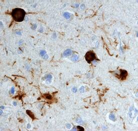 <b>Biological Strategies Validation. </b>APP/Protease Nexin II phosphorylated at T668 was detected in immersion fixed paraffin-embedded sections of human Alzheimer's brain (cortex) using Rabbit Anti-Human/Mouse Phospho-APP/Protease Nexin II (T668) Antigen Affinity-purified Polyclonal Antibody (Catalog # AF2508) at 10 µg/mL overnight at 4 °C. Before incubation with the primary antibody, tissue was subjected to heat-induced epitope retrieval using Antigen Retrieval Reagent-Basic (Catalog # CTS013). Tissue was stained using the Anti-Rabbit HRP-DAB Cell & Tissue Staining Kit (brown; Catalog # CTS005) and counterstained with hematoxylin (blue). View our protocol for Chromogenic IHC Staining of Paraffin-embedded Tissue Sections.