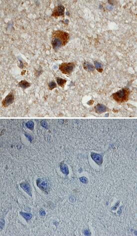 APP/Protease Nexin II was detected in immersion fixed paraffin-embedded sections of human Alzheimer's disease brain (cortex) using 8 &micro;g/mL Human/Mouse Phospho-APP/Protease Nexin II (T668) Monoclonal Antibody (Catalog # MAB2508) overnight at 4 &deg;C. Tissue was stained with the Anti-Mouse HRP-DAB Cell & Tissue Staining Kit (brown; Catalog # CTS002) and counterstained with hematoxylin (blue). View our protocol for Chromogenic IHC Staining of Paraffin-embedded Tissue Sections.