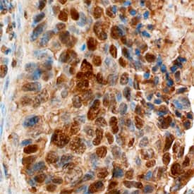 <b>Biological Strategies Validation. </b>ATM was detected in immersion fixed paraffin-embedded sections of human breast using Sheep Anti-Human ATM Antigen Affinity-purified Polyclonal Antibody (Catalog # AF2290) at 10 µg/mL overnight at 4 °C. Before incubation with the primary antibody, tissue was subjected to heat-induced epitope retrieval using Antigen Retrieval Reagent-Basic (Catalog # CTS013). Tissue was stained using the Anti-Sheep HRP-DAB Cell & Tissue Staining Kit (brown; Catalog # CTS019) and counterstained with hematoxylin (blue). Specific staining was localized to cytoplasm and nuclei. View our protocol for Chromogenic IHC Staining of Paraffin-embedded Tissue Sections.