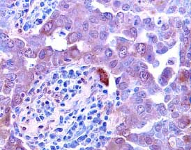 Activin A was detected in immersion fixed paraffin-embedded sections of human breast cancer tissue using 5 µg/mL Goat Anti-Human/Mouse/Rat Activin A  beta A Subunit Antigen Affinity-purified Polyclonal Antibody (Catalog # AF338) overnight at 4 °C. Tissue was stained (red) and counterstained with hematoxylin (blue). View our protocol for Chromogenic IHC Staining of Paraffin-embedded Tissue Sections.