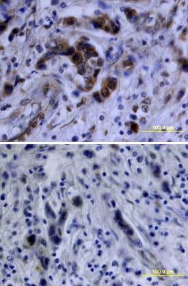 <b>Biological Strategies Validation. </b>Akt phosphorylated at S473 was detected in immersion fixed paraffin-embedded sections of human breast cancer tissue using Rabbit Anti-Human/Mouse/Rat Phospho-Akt (S473) Antigen Affinity-purified Polyclonal Antibody (Catalog # AF887) at 10 µg/mL overnight at 4 °C. Tissue was stained using the Anti-Rabbit HRP-DAB Cell & Tissue Staining Kit (brown; CTS005) and counterstained with hematoxylin (blue). Lower panel shows a lack of labeling if primary antibodies are omitted and tissue is stained only with secondary antibody followed by incubation with detection reagents. View our protocol for Chromogenic IHC Staining of Paraffin-embedded Tissue Sections.
