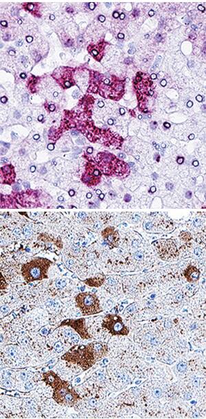 <b>Orthogonal Strategies Validation. </b>Serum Albumin mRNA was detected in formalin-fixed paraffin-embedded tissue sections of human liver probed with ACD RNAScope®Probe (Catalog # 600941) and stained using ACD RNAscope®2.5 HD Detection Reagents-Red (top image, Catalog # 32260). Adjacent tissue section was processed for immunohistochemistry using R&D Systems Mouse Anti-Human Serum Albumin Monoclonal Antibody (Catalog # MAB1455) at 0.05 ug/mL for 1 hour at room temperature followed by incubation with the Anti-Mouse IgG VisUCyte HRP Polymer Antibody (R&D Systems, Catalog # VC001) and DAB chromogen (lower image, yellow-brown). Tissues were counterstained with hematoxylin (blue).