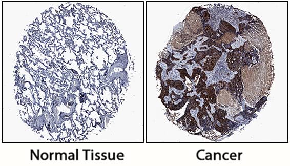 Aldehyde Dehydrogenase 3-A1/ALDH3A1 was detected in immersion fixed paraffin-embedded sections of human normal lung and lung cancer tissue using Sheep Anti-Human Aldehyde Dehydrogenase 3-A1/ALDH3A1 Antigen Affinity-purified Polyclonal Antibody (Catalog # AF6705) at 3 µg/mL overnight at 4 °C. Tissue was stained using the Anti-Sheep HRP-DAB Cell & Tissue Staining Kit (brown; Catalog # CTS019) and counterstained with hematoxylin (blue). Specific staining was localized to cytoplasm of cancer cells. View our protocol for Chromogenic IHC Staining of Paraffin-embedded Tissue Sections.