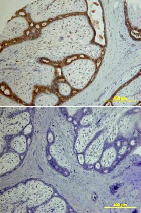Amphiregulin was detected in immersion fixed paraffin-embedded sections of human breast using Goat Anti-Human Amphiregulin Antigen Affinity-purified Polyclonal Antibody (Catalog # AF262) at 15 µg/mL overnight at 4 °C. Tissue was stained using the Anti-Goat HRP-DAB Cell & Tissue Staining Kit (brown; Catalog # CTS008) and counterstained with hematoxylin (blue). Lower panel shows a lack of labeling if primary antibodies are omitted and tissue is stained only with secondary antibody followed by incubation with detection reagents. View our protocol for Chromogenic IHC Staining of Paraffin-embedded Tissue Sections.