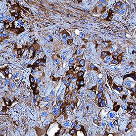 Apolipoprotein A-I/ApoA1 was detected in immersion fixed paraffin-embedded sections of human liver cancer tissue using Rabbit Anti-Human Apolipoprotein A-I/ApoA1 Monoclonal Antibody (Catalog # MAB36641) at 1 µg/mL for 1 hour at room temperature followed by incubation with the Anti-Rabbit IgG VisUCyte™ HRP Polymer Antibody (Catalog # VC003). Tissue was stained using DAB (brown) and counterstained with hematoxylin (blue). Specific staining was localized to cytoplasm in cancer cells. View our protocol for IHC Staining with VisUCyte HRP Polymer Detection Reagents.