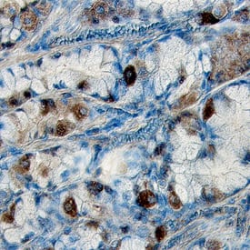 Axl phosphorylated at site Y779 was detected in immersion fixed paraffin-embedded sections of human stomach cancer tissue using Human Phospho-Axl (Y779) Antigen Affinity-purified Polyclonal Antibody (Catalog # AF2228) at 15 µg/mL overnight at 4 °C. Tissue was stained using the Anti-Rabbit HRP-DAB Cell & Tissue Staining Kit (brown; CTS005) and counterstained with hematoxylin (blue). Specific labeling was localized to the cytoplasm of epithelial cells. View our protocol for Chromogenic IHC Staining of Paraffin-embedded Tissue Sections.