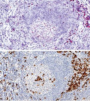 <b>Orthogonal Strategies Validation. </b>B7-1/CD80 mRNA was detected in formalin-fixed paraffin-embedded tissue sections of human tonsil probed with ACD RNAScope®Probe (Catalog # 42471) and stained using ACD RNAscope®2.5 HD Duplex Detection Reagents (red, Catalog # 322500). Adjacent tissue section was processed for immunohistochemistry using R&D Systems Mouse Anti-Human B7-1/CD80 Monoclonal Antibody (Catalog# MAB140) at 5ug/mL with overnight incubation at 4 °C followed by incubation with the Anti-Mouse IgG VisUCyte HRP Polymer Antibody (R&D Systems, Catalog # VC001) and DAB chromogen (lower image, brown). Tissues were counterstained with hematoxylin (blue).