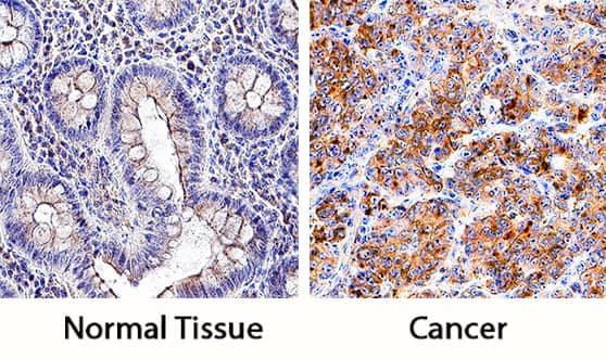 PD-L1/B7-H1 was detected in immersion fixed paraffin-embedded sections of normal human colon (left panel) and human colon cancer tissue (right panel) using Goat Anti-Human PD-L1/B7-H1 Antigen Affinity-purified Polyclonal Antibody (Catalog # AF156) at 5 µg/mL overnight at 4 °C. Tissue was stained using the Anti-Goat HRP-DAB Cell & Tissue Staining Kit (brown; Catalog # CTS008) and counterstained with hematoxylin (blue). Specific staining was localized to cell membranes and cytoplasm. View our protocol for Chromogenic IHC Staining of Paraffin-embedded Tissue Sections.