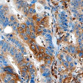 PD-L1/B7-H1 was detected in formalin fixed paraffin-embedded sections of human colon cancer using Mouse Anti-Human PD-L1/B7-H1 Monoclonal Antibody (Catalog # MAB1561) at 15 µg/mL overnight at 4 °C. Tissue was stained using the Anti-Mouse HRP-DAB Cell & Tissue Staining Kit (brown; Catalog # CTS002) and counterstained with hematoxylin (blue). Specific staining was observed in the cytoplasm. View our protocol for Chromogenic IHC Staining of Paraffin-embedded Tissue Sections.