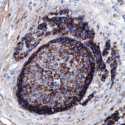 B7-H4 was detected in immersion fixed paraffin-embedded sections of human breast cancer tissue using Mouse Anti-Human B7-H4 Monoclonal Antibody (Catalog # MAB65761R) at 1.7 µg/mL for 1 hour at room temperature followed by incubation with the Anti-Mouse IgG VisUCyte™ HRP Polymer Antibody (Catalog # VC001). Before incubation with the primary antibody, tissue was subjected to heat-induced epitope retrieval using Antigen Retrieval Reagent-Basic (Catalog # CTS013). Tissue was stained using DAB (brown) and counterstained with hematoxylin (blue). Specific staining was localized to cytoplasm. View our protocol for IHC Staining with VisUCyte HRP Polymer Detection Reagents.