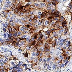 B7-H4 was detected in immersion fixed paraffin-embedded sections of human breast cancer tissue using Rabbit Anti-Human B7-H4 Monoclonal Antibody (Catalog # MAB65764) at 3 µg/mL for 1 hour at room temperature followed by incubation with the Anti-Rabbit IgG VisUCyte™ HRP Polymer Antibody (Catalog # VC003). Before incubation with the primary antibody, tissue was subjected to heat-induced epitope retrieval using Antigen Retrieval Reagent-Basic (Catalog # CTS013). Tissue was stained using DAB (brown) and counterstained with hematoxylin (blue). Specific staining was localized to cell surfaces in cancer cells. View our protocol for IHC Staining with VisUCyte HRP Polymer Detection Reagents.