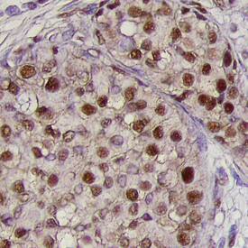BMI‑1 was detected in immersion fixed paraffin-embedded sections of human breast cancer tissue using Human BMI‑1 Monoclonal Antibody (Catalog # MAB33342) at 25 &micro;g/mL overnight at 4 &deg;C. Tissue was stained using the Anti-Mouse HRP-DAB Cell & Tissue Staining Kit (brown; Catalog # CTS002) and counterstained with hematoxylin (blue). Specific labeling was localized to the nuclei of epithelial cells. View our protocol for Chromogenic IHC Staining of Paraffin-embedded Tissue Sections.