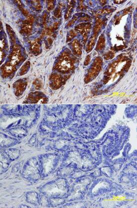BMP-7 was detected in immersion fixed paraffin-embedded sections of human prostate using Human BMP-7 Monoclonal Antibody (Catalog # MAB3542) at 25 µg/mL overnight at 4 °C. Tissue was stained using the Anti-Mouse HRP-DAB Cell & Tissue Staining Kit (brown; Catalog # CTS002) and counterstained with hematoxylin (blue). Lower panel shows a lack of labeling if primary antibodies are omitted and tissue is stained only with secondary antibody followed by incubation with detection reagents. View our protocol for Chromogenic IHC Staining of Paraffin-embedded Tissue Sections.