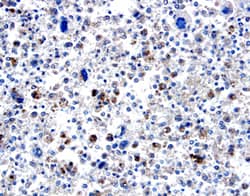 BMP-8 was detected in immersion fixed paraffin-embedded sections of human osteosarcoma using 15 µg/mL Goat Anti-Human BMP-8 Antigen Affinity-purified Polyclonal Antibody (Catalog # AF1073) overnight at 4 °C. Tissue was stained with the Anti-Goat HRP-DAB Cell & Tissue Staining Kit (brown; Catalog # CTS008) and counterstained with hematoxylin (blue). View our protocol for Chromogenic IHC Staining of Paraffin-embedded Tissue Sections.